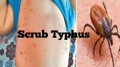 What is Scrub Typhus and What is the Treatment of it