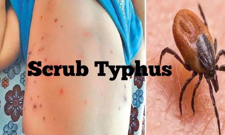 What is Scrub Typhus and What is the Treatment of it